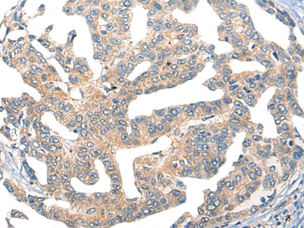 GPR55 Antibody - Immunohistochemistry of paraffin-embedded Human liver cancer tissue  using GPR55 Polyclonal Antibody at dilution of 1:55(×200)