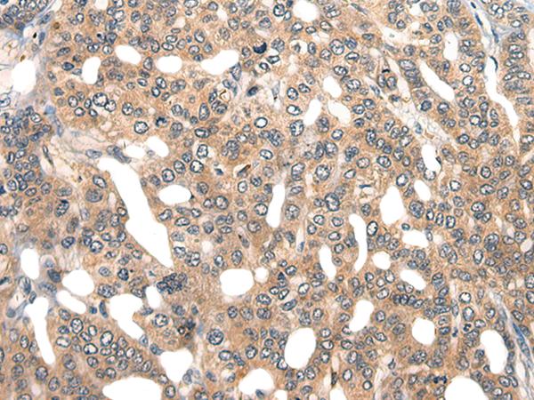 GPR55 Antibody - Immunohistochemistry of paraffin-embedded Human liver cancer tissue  using GPR55 Polyclonal Antibody at dilution of 1:40(×200)