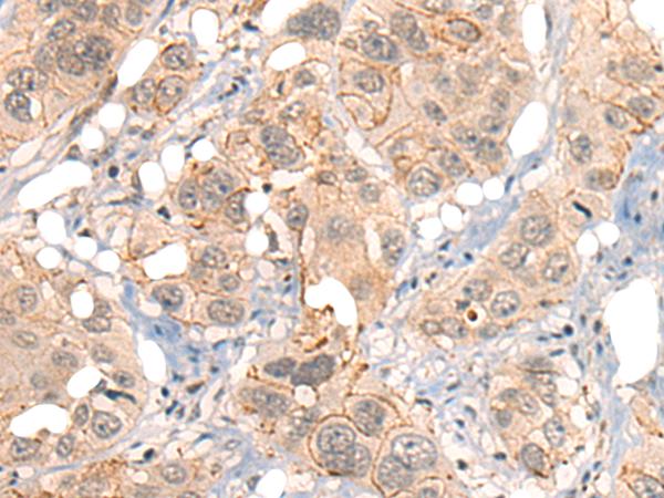 GPR55 Antibody - Immunohistochemistry of paraffin-embedded Human esophagus cancer tissue  using GPR55 Polyclonal Antibody at dilution of 1:40(×200)