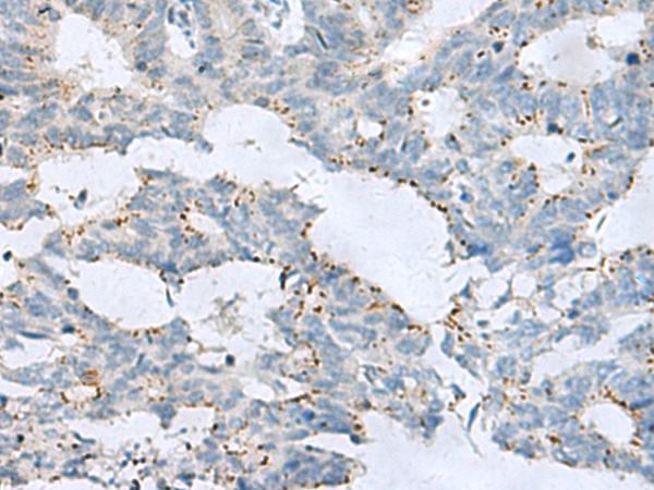 GPR6 Antibody - Immunohistochemistry of paraffin-embedded Human colorectal cancer tissue  using GPR6  Polyclonal Antibody at dilution of 1:80(×200)