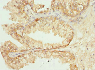 GPR68 / OGR1 Antibody - Immunohistochemistry of paraffin-embedded human prostata cancer at dilution 1:100