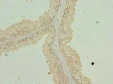 GPR68 / OGR1 Antibody - Immunohistochemistry of paraffin-embedded human prostata cancer at dilution 1:100