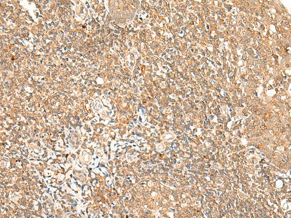 GPR89A Antibody - Immunohistochemistry of paraffin-embedded Human tonsil tissue  using GPR89A/GPR89B Polyclonal Antibody at dilution of 1:25(×200)