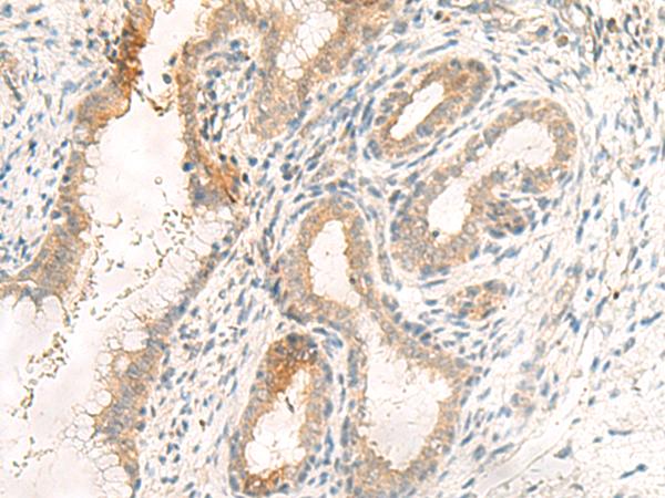 GPR89A Antibody - Immunohistochemistry of paraffin-embedded Human cervical cancer tissue  using GPR89A/GPR89B Polyclonal Antibody at dilution of 1:25(×200)