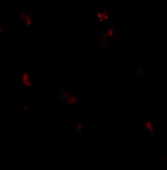 GPRASP1 / GASP-1 Antibody - Immunofluorescence of GPRASP1 in human breast carcinoma tissue with GPRASP1 antibody at 20 ug/ml.