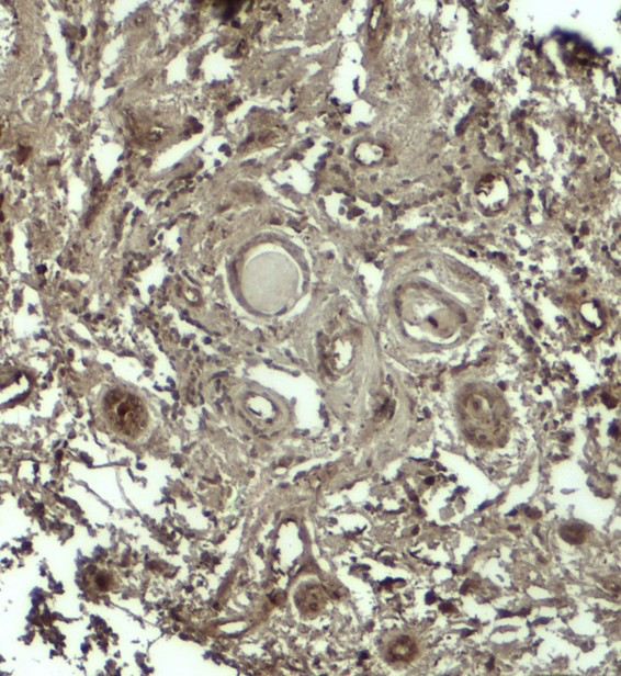 GPRASP1 / GASP-1 Antibody - Immunohistochemistry of GPRASP1 in human breast carcinoma tissue with GPRASP12 antibody at 5 ug/ml.