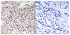 GPRIN3 Antibody - Peptide - + Immunohistochemistry analysis of paraffin-embedded human breast carcinoma tissue using GPRIN3 antibody.