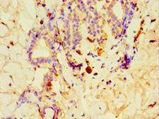 GPS1 / CSN1 Antibody - Immunohistochemistry of paraffin-embedded human breast cancer using antibody at 1:100 dilution.