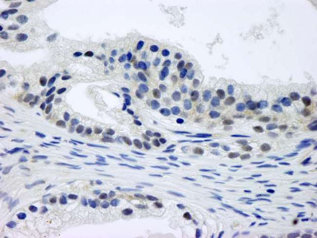GPS1 / CSN1 Antibody - Detection of Human CSN1 by Immunohistochemistry. Sample: FFPE section of human prostate-nodular hypertrophy. Antibody: Affinity purified rabbit anti-CSN1 used at a dilution of 1:250.