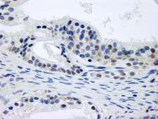 GPS1 / CSN1 Antibody - Detection of Human CSN1 by Immunohistochemistry. Sample: FFPE section of human prostate-nodular hypertrophy. Antibody: Affinity purified rabbit anti-CSN1 used at a dilution of 1:250.