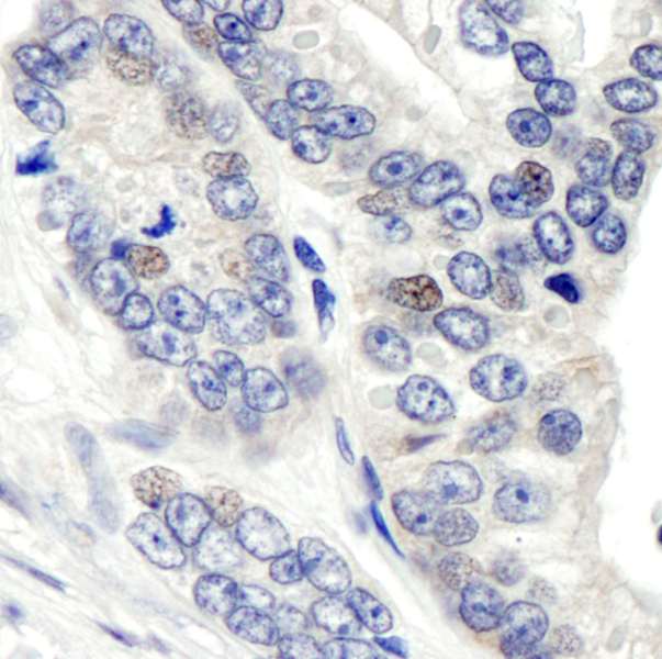 GPS1 / CSN1 Antibody - Detection of Human CSN1 by Immunohistochemistry. Sample: FFPE section of human prostate carcinoma. Antibody: Affinity purified rabbit anti-CSN1 used at a dilution of 1:1000 (1 ug/ml). Detection: DAB.