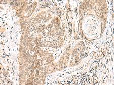 GPSM1 / AGS3 Antibody - Immunohistochemistry of paraffin-embedded Human esophagus cancer tissue  using GPSM1 Polyclonal Antibody at dilution of 1:55(×200)
