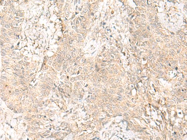 GPSM1 / AGS3 Antibody - Immunohistochemistry of paraffin-embedded Human ovarian cancer tissue  using GPSM1 Polyclonal Antibody at dilution of 1:55(×200)