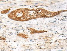 GPSM1 / AGS3 Antibody - Immunohistochemistry of paraffin-embedded Human esophagus cancer tissue  using GPSM1 Polyclonal Antibody at dilution of 1:85(×200)