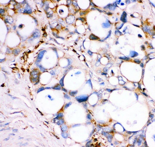 GPX1 / Glutathione Peroxidase Antibody - GPX1 antibody IHC-paraffin: Human Intestinal Cancer Tissue.