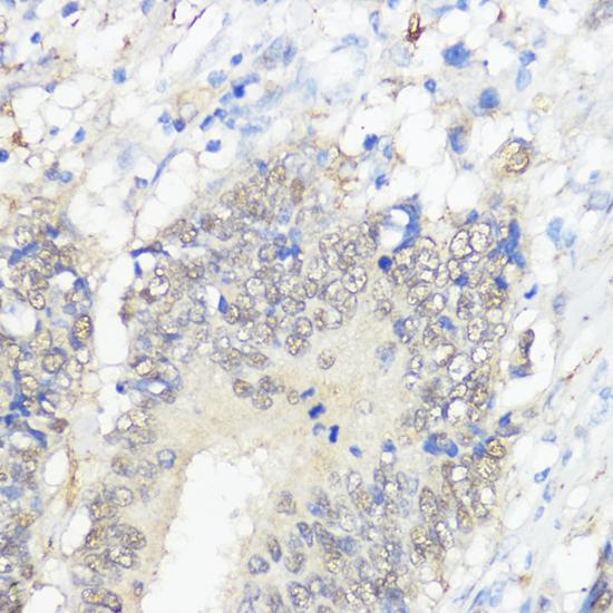 GPX2 Antibody - Immunohistochemistry of paraffin-embedded Human colon carcinoma using GPX2 Polyclonal Antibody at dilution of 1:100 (40x lens).