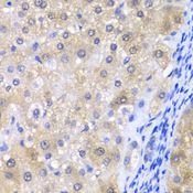 GPX4 / MCSP Antibody - Immunohistochemistry of paraffin-embedded human liver injury using GPX4 antibody at dilution of 1:200 (40x lens).