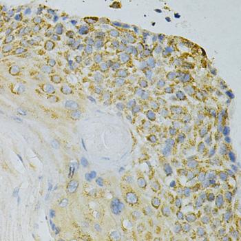 GPX4 / MCSP Antibody - Immunohistochemistry of paraffin-embedded Human esophageal cancer using GPX4 Polyclonal Antibody at dilution of 1:200 (40x lens).