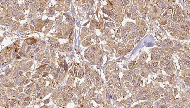 GPX5 Antibody - 1:100 staining human Melanoma tissue by IHC-P. The sample was formaldehyde fixed and a heat mediated antigen retrieval step in citrate buffer was performed. The sample was then blocked and incubated with the antibody for 1.5 hours at 22°C. An HRP conjugated goat anti-rabbit antibody was used as the secondary.