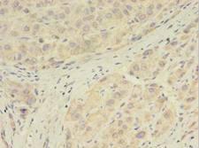 GPX7 Antibody - Immunohistochemistry of paraffin-embedded human liver cancer using antibody at 1:100 dilution.