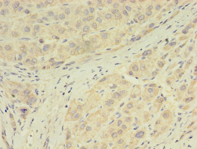 GPX7 Antibody - Immunohistochemistry of paraffin-embedded human liver cancer using GPX7 Antibody at dilution of 1:100