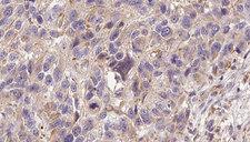 GPX7 Antibody - 1:100 staining human Melanoma tissue by IHC-P. The sample was formaldehyde fixed and a heat mediated antigen retrieval step in citrate buffer was performed. The sample was then blocked and incubated with the antibody for 1.5 hours at 22°C. An HRP conjugated goat anti-rabbit antibody was used as the secondary.