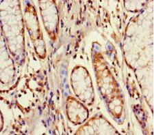 GPX8 Antibody - Immunohistochemistry of paraffin-embedded human gastric cancer using GPX8 Antibody at dilution of 1:100