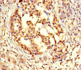 GPX8 Antibody - Immunohistochemistry of paraffin-embedded human pancreatic cancer using GPX8 Antibody at dilution of 1:100
