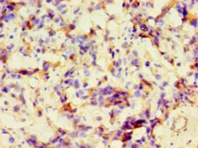 GRA1 / Dense granule protein 1 Antibody - Immunohistochemistry of paraffin-embedded human bladder cancer using antibody at 1:100 dilution.  This image was taken for the unconjugated form of this product. Other forms have not been tested.