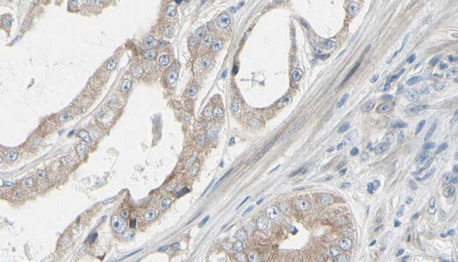 GRAP Antibody - 1:100 staining human prostate tissue by IHC-P. The sample was formaldehyde fixed and a heat mediated antigen retrieval step in citrate buffer was performed. The sample was then blocked and incubated with the antibody for 1.5 hours at 22°C. An HRP conjugated goat anti-rabbit antibody was used as the secondary.
