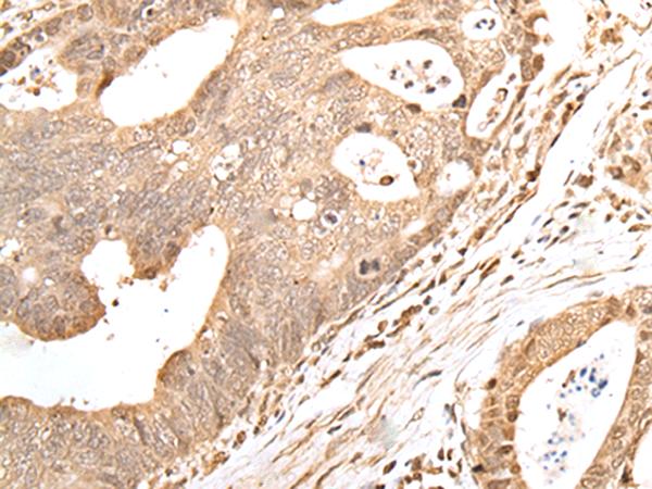 GRAP Antibody - Immunohistochemistry of paraffin-embedded Human gastric cancer tissue  using GRAP Polyclonal Antibody at dilution of 1:40(×200)