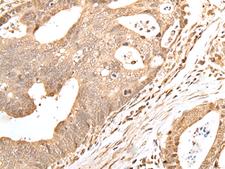 GRAP Antibody - Immunohistochemistry of paraffin-embedded Human gastric cancer tissue  using GRAP Polyclonal Antibody at dilution of 1:40(×200)