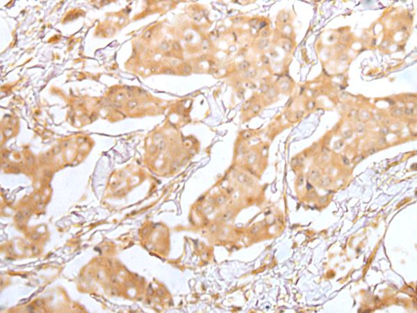 GRAP Antibody - Immunohistochemistry of paraffin-embedded Human breast cancer tissue  using GRAP Polyclonal Antibody at dilution of 1:40(×200)