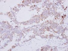 GRAP2 / GRID Antibody - IHC of paraffin-embedded Colon ca using GRAP2 antibody at 1:500 dilution.