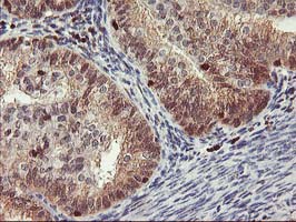 GRAP2 / GRID Antibody - IHC of paraffin-embedded Adenocarcinoma of Human endometrium tissue using anti-GRAP2 mouse monoclonal antibody.