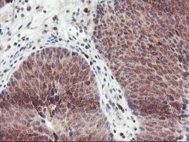 GRAP2 / GRID Antibody - IHC of paraffin-embedded Carcinoma of Human bladder tissue using anti-GRAP2 mouse monoclonal antibody.
