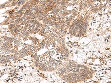 GRASP Antibody - Immunohistochemistry of paraffin-embedded Human esophagus cancer tissue  using GRASP Polyclonal Antibody at dilution of 1:150(×200)