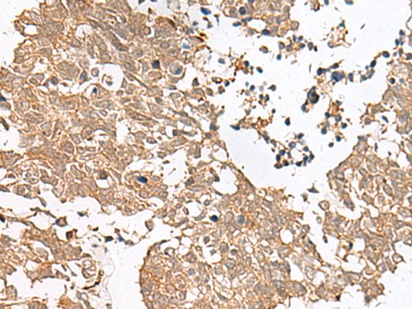 GRASP Antibody - Immunohistochemistry of paraffin-embedded Human lung cancer tissue  using GRASP Polyclonal Antibody at dilution of 1:60(×200)