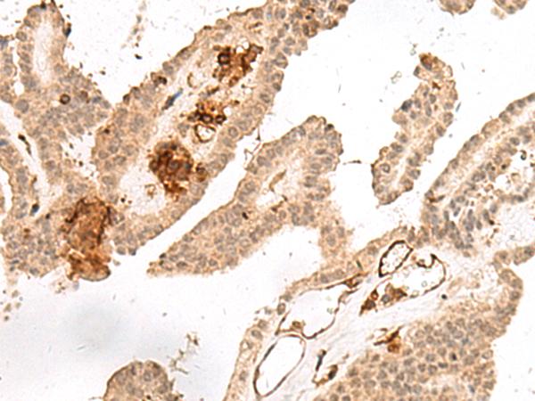 GRASP Antibody - Immunohistochemistry of paraffin-embedded Human thyroid cancer tissue  using GRASP Polyclonal Antibody at dilution of 1:60(×200)