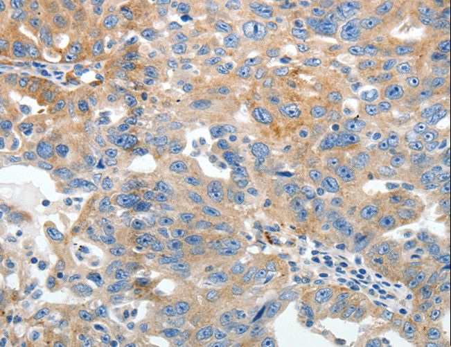 Gravin / AKAP12 Antibody - Immunohistochemistry of paraffin-embedded Human ovarian cancer using AKAP12 Polyclonal Antibody at dilution of 1:40.