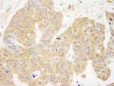 GRB10 Antibody - Detection of Human GRB10 by Immunohistochemistry. Sample: FFPE section of human ovarian carcinoma. Antibody: Affinity purified rabbit anti-GRB10 used at a dilution of 1:250.