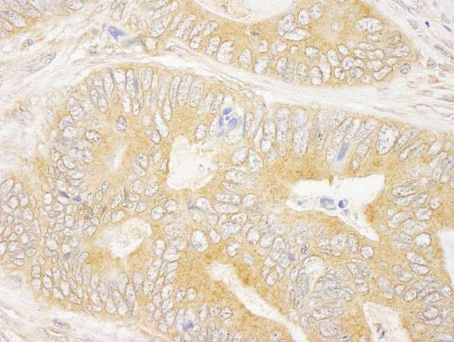 GRB10 Antibody - Detection of Human GRB10 by Immunohistochemistry. Sample: FFPE section of human colon carcinoma. Antibody: Affinity purified rabbit anti-GRB10 used at a dilution of 1:250.