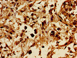 GRB10 Antibody - Immunohistochemistry image of paraffin-embedded human melanoma cancer at a dilution of 1:100