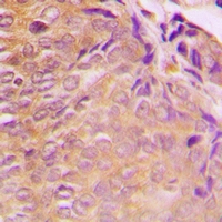 GRB10 Antibody - Immunohistochemical analysis of GRB10 staining in human breast cancer formalin fixed paraffin embedded tissue section. The section was pre-treated using heat mediated antigen retrieval with sodium citrate buffer (pH 6.0). The section was then incubated with the antibody at room temperature and detected using an HRP polymer system. DAB was used as the chromogen. The section was then counterstained with hematoxylin and mounted with DPX.