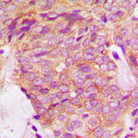 GRB14 Antibody - Immunohistochemical analysis of GRB14 staining in human breast cancer formalin fixed paraffin embedded tissue section. The section was pre-treated using heat mediated antigen retrieval with sodium citrate buffer (pH 6.0). The section was then incubated with the antibody at room temperature and detected using an HRP conjugated compact polymer system. DAB was used as the chromogen. The section was then counterstained with hematoxylin and mounted with DPX.