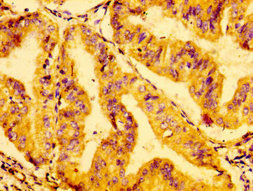GRB14 Antibody - Immunohistochemistry image at a dilution of 1:100 and staining in paraffin-embedded human cervical cancer performed on a Leica BondTM system. After dewaxing and hydration, antigen retrieval was mediated by high pressure in a citrate buffer (pH 6.0) . Section was blocked with 10% normal goat serum 30min at RT. Then primary antibody (1% BSA) was incubated at 4 °C overnight. The primary is detected by a biotinylated secondary antibody and visualized using an HRP conjugated SP system.