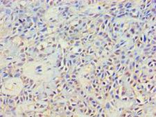 GRB4 / NCK2 Antibody - Immunohistochemistry of paraffin-embedded human breast cancer using antibody at 1:100 dilution.  This image was taken for the unconjugated form of this product. Other forms have not been tested.