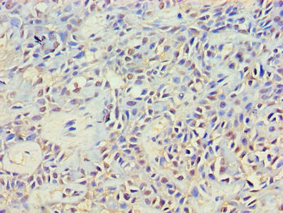 GRB4 / NCK2 Antibody - Immunohistochemistry of paraffin-embedded human breast cancer using NCK2 Antibody at dilution of 1:100