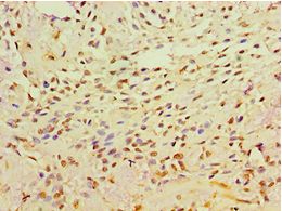 GRB4 / NCK2 Antibody - Immunohistochemistry of paraffin-embedded human breast cancer using antibody at 1:100 dilution.