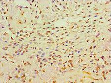 GRB4 / NCK2 Antibody - Immunohistochemistry of paraffin-embedded human breast cancer using antibody at 1:100 dilution.